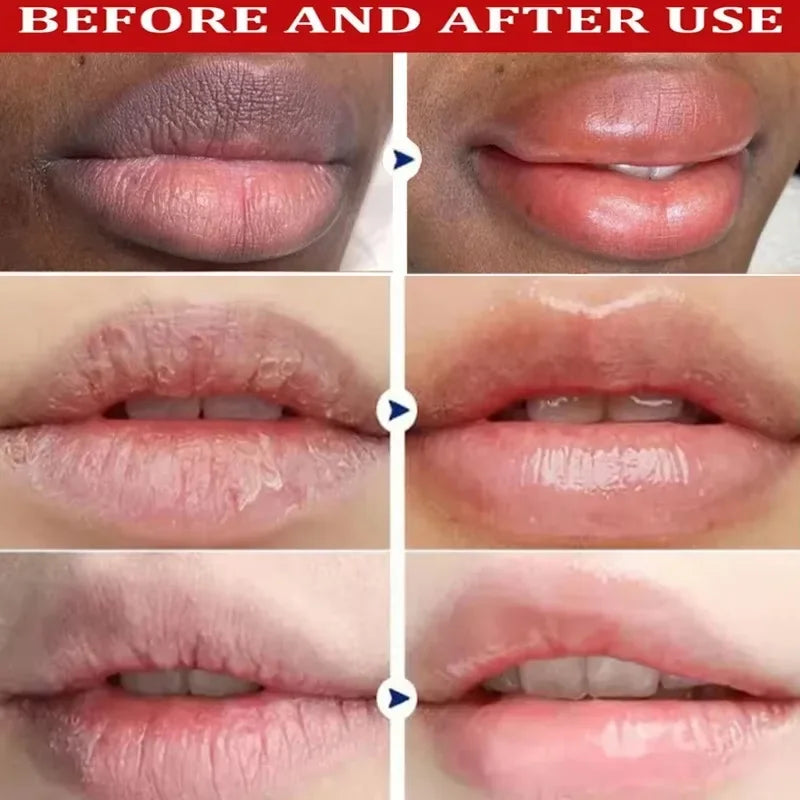 Vitamina c remover bálsamo labial escuro clarear melanina